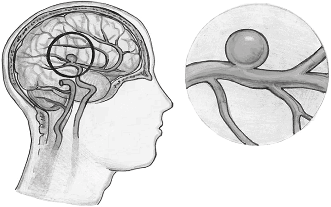 Иллюстрация к книге — Хрупкий мозг. Инсульту не быть? [img_68.jpg]