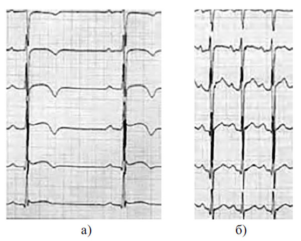 Иллюстрация к книге — Сердце спортсмена. Актуальные проблемы спортивной кардиологии [i_038.jpg]