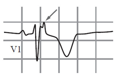 Иллюстрация к книге — Сердце спортсмена. Актуальные проблемы спортивной кардиологии [i_064.jpg]